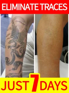 Видалення тату: гель для глибокого видалення упертих тату