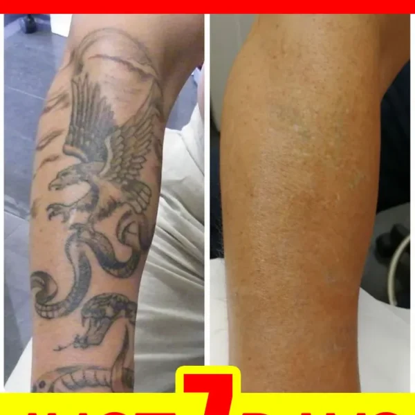 Видалення тату: гель для глибокого видалення упертих тату