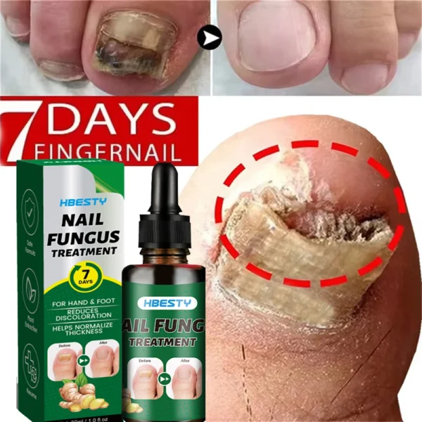 Лікування грибка нігтів: Серум для видалення грибка на нігтях