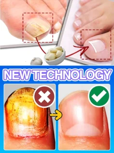 Fungal Nail Repair - Швидке лікування грибка нігтів