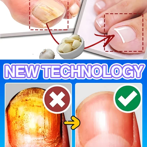 Fungal Nail Repair - Швидке лікування грибка нігтів