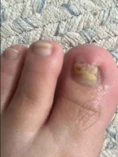 Лікування грибка нігтів: Серум для видалення грибка на нігтях photo review