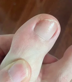 Fungal Nail Repair - Швидке лікування грибка нігтів photo review