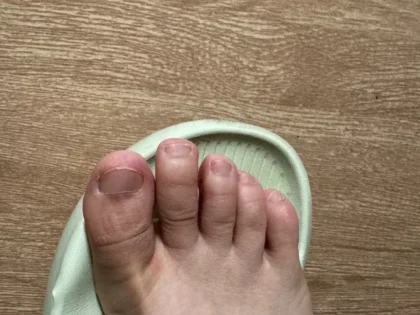 Fungal Nail Repair - Швидке лікування грибка нігтів photo review