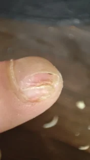 Лікування грибка нігтів: Серум для видалення грибка на нігтях photo review