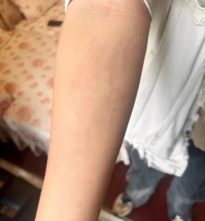 Видалення тату: гель для глибокого видалення упертих тату photo review