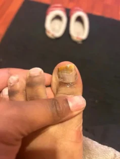 Лікування грибка нігтів: Серум для видалення грибка на нігтях photo review