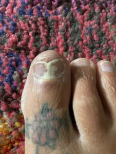 Лікування грибка нігтів: Серум для видалення грибка на нігтях photo review