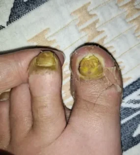 Fungal Nail Repair - Швидке лікування грибка нігтів photo review