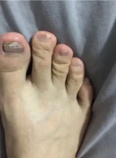 Лікування грибка нігтів: Серум для видалення грибка на нігтях photo review