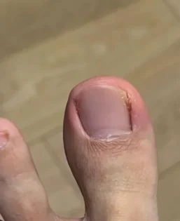 Fungal Nail Repair - Швидке лікування грибка нігтів photo review