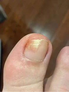 Fungal Nail Repair - Швидке лікування грибка нігтів photo review