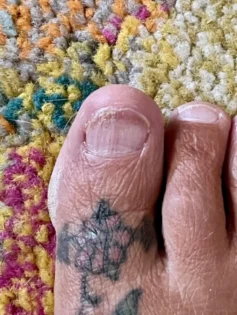 Лікування грибка нігтів: Серум для видалення грибка на нігтях photo review