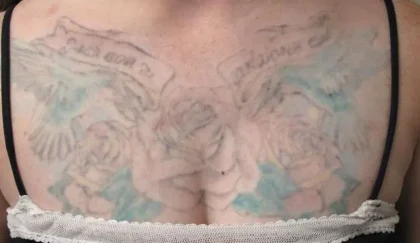 Видалення тату: гель для глибокого видалення упертих тату photo review