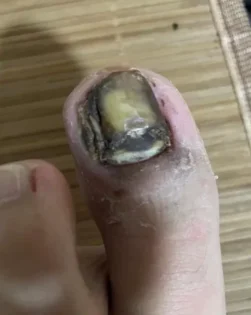 Fungal Nail Repair - Швидке лікування грибка нігтів photo review