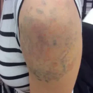 Видалення тату: гель для глибокого видалення упертих тату photo review