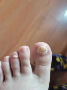 Fungal Nail Repair - Швидке лікування грибка нігтів photo review