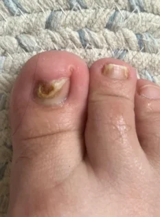 Лікування грибка нігтів: Серум для видалення грибка на нігтях photo review