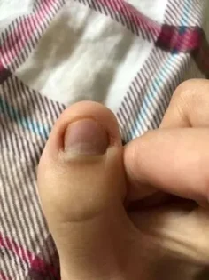 Лікування грибка нігтів – ефективне рішення для відновлення photo review