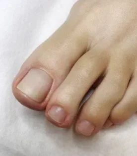 Лікування грибка нігтів – ефективне рішення для відновлення photo review