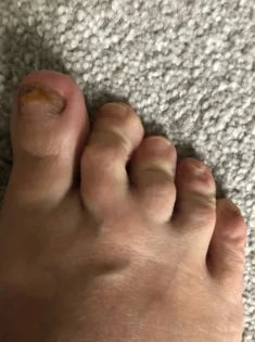 Лікування грибка нігтів: Серум для видалення грибка на нігтях photo review