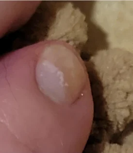 Лікування грибка нігтів: Серум для видалення грибка на нігтях photo review