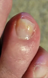 Лікування грибка нігтів: Серум для видалення грибка на нігтях photo review