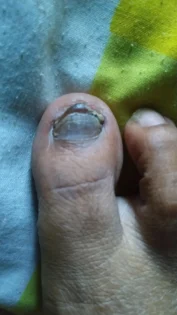 Лікування грибка нігтів – ефективне рішення для відновлення photo review