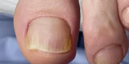 Лікування грибка нігтів – ефективне рішення для відновлення photo review